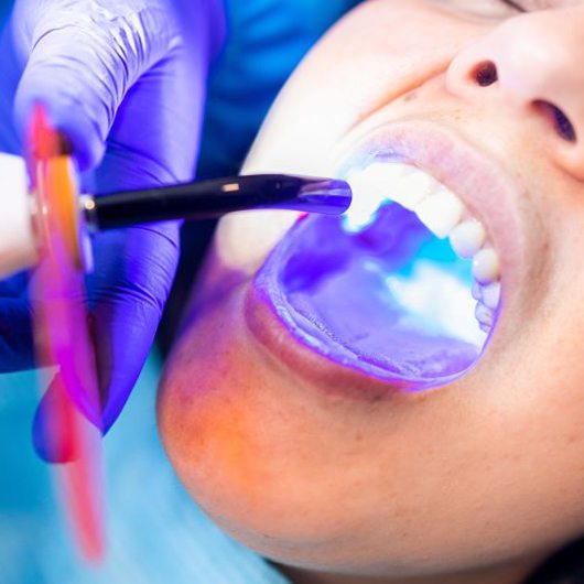 Dental curing light being used to harden cosmetic bonding