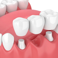 Exploded illustration of traditional dental bridge and altered teeth
