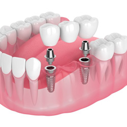 Digital illustration of implant bridge