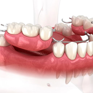 Illustration of partial denture for lower arch