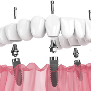 Illustration of implant denture against white background