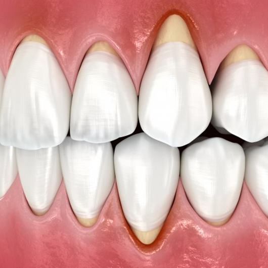 Illustration of gum recession?