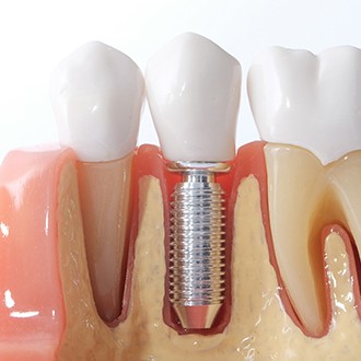Closeup of sample dental implant in model arch