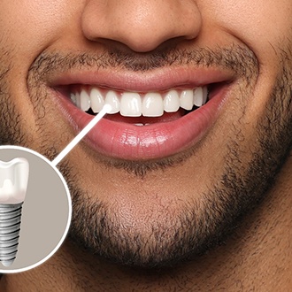 Nose-to-chin view of man smiling with front tooth indicated as implant