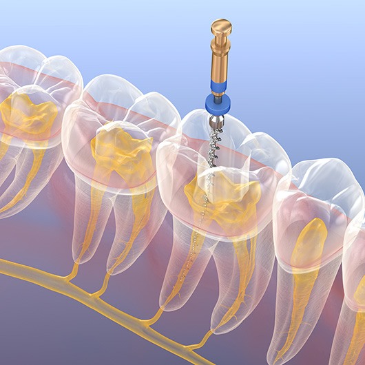 a 3D illustration showing the root canal process
