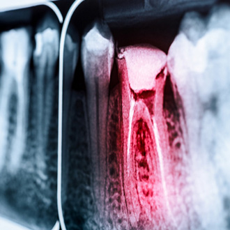 Factors that can affect the cost of a root canal include which teeth need to be treated