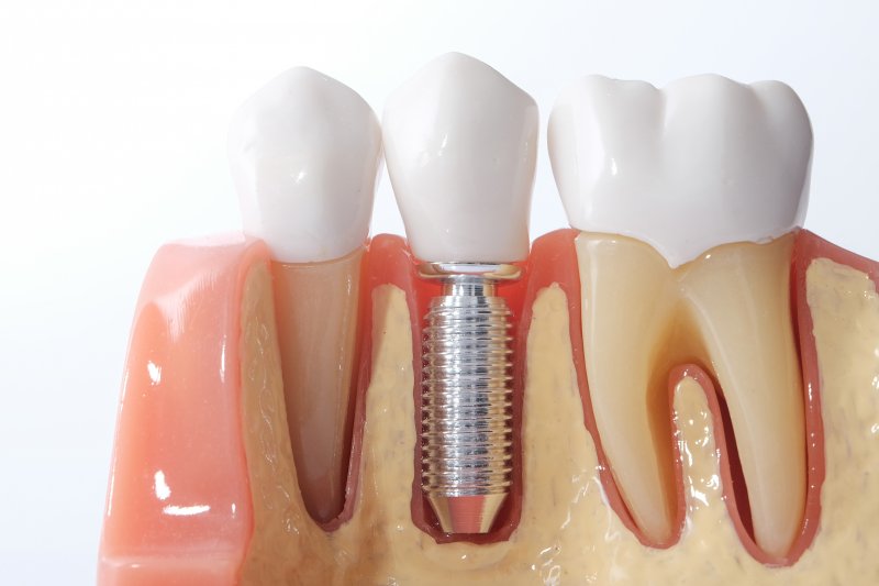 single dental implant in a mold