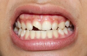 Close-up of chipped front tooth.